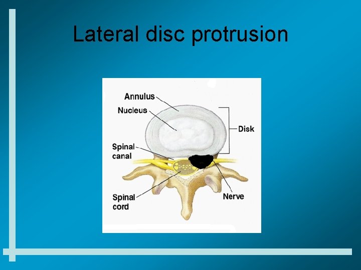 Lateral disc protrusion 