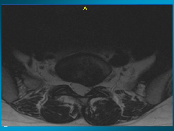 MRI scan slide #5 