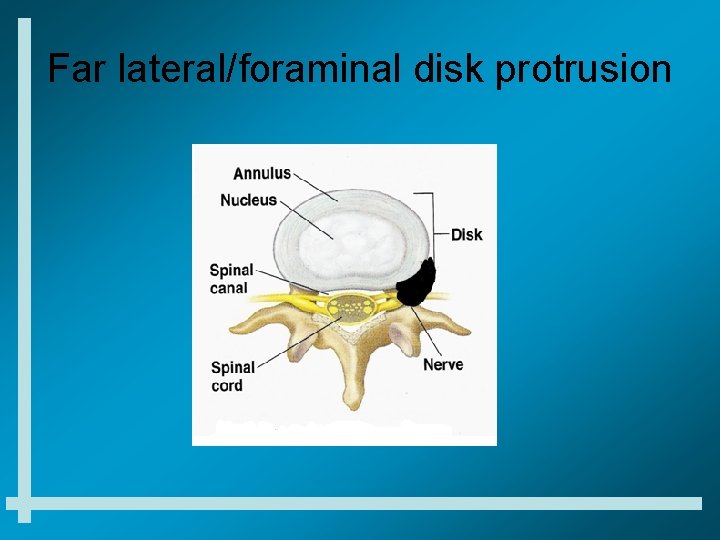 Far lateral/foraminal disk protrusion 