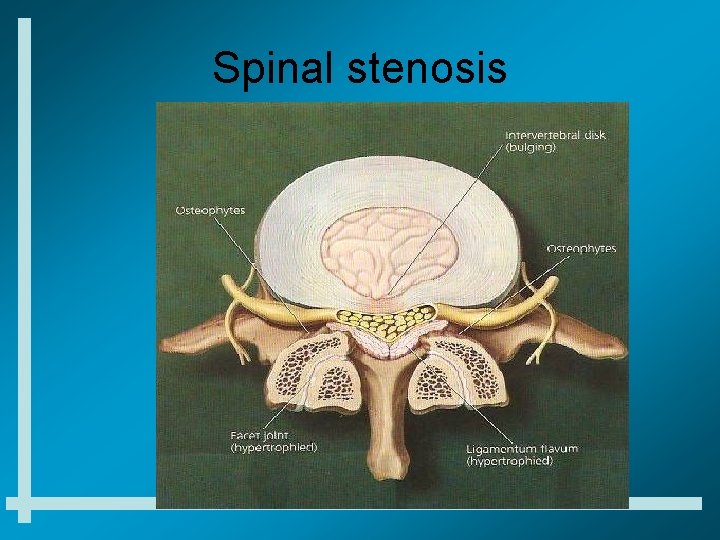 Spinal stenosis 