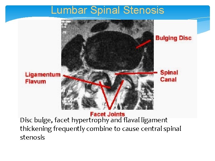 Lumbar Spinal Stenosis Disc bulge, facet hypertrophy and flaval ligament thickening frequently combine to