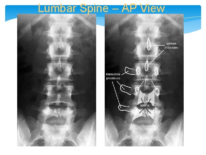 Lumbar Spine – AP View 