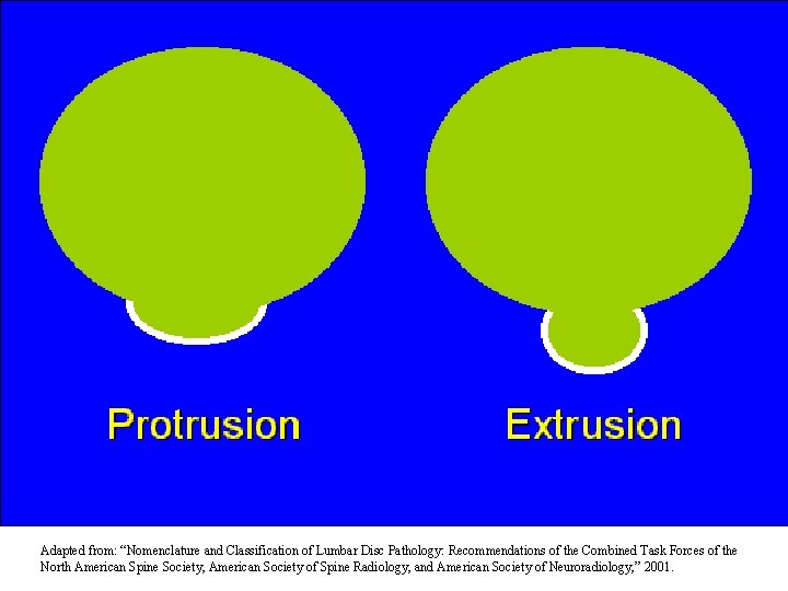 Adapted from: “Nomenclature and Classification of Lumbar Disc Pathology: Recommendations of the Combined Task