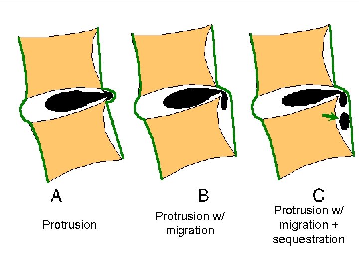 Protrusion w/ migration + sequestration 