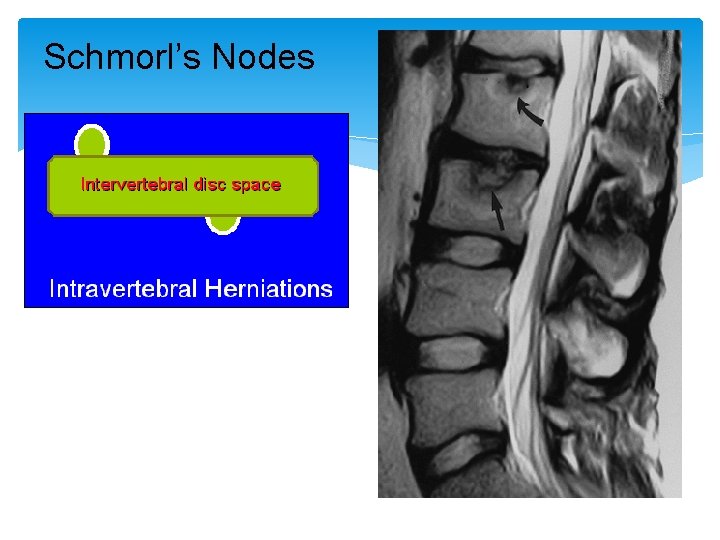 Schmorl’s Nodes 