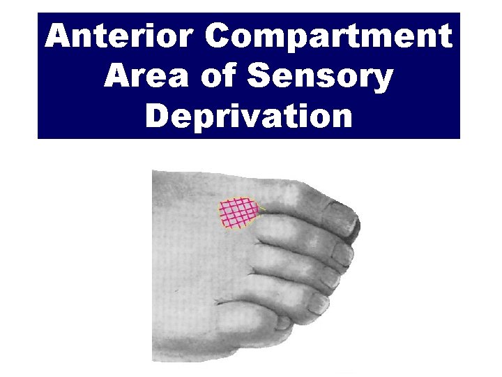 Anterior Compartment Area of Sensory Deprivation 