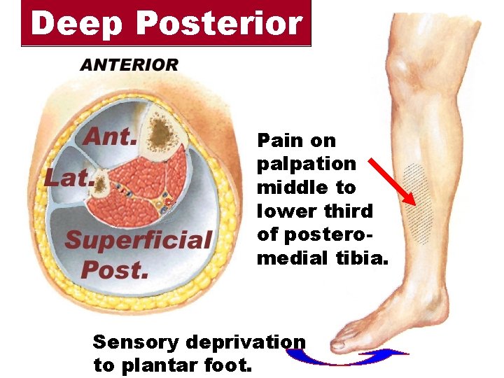 Deep Posterior Pain on palpation middle to lower third of posteromedial tibia. Sensory deprivation