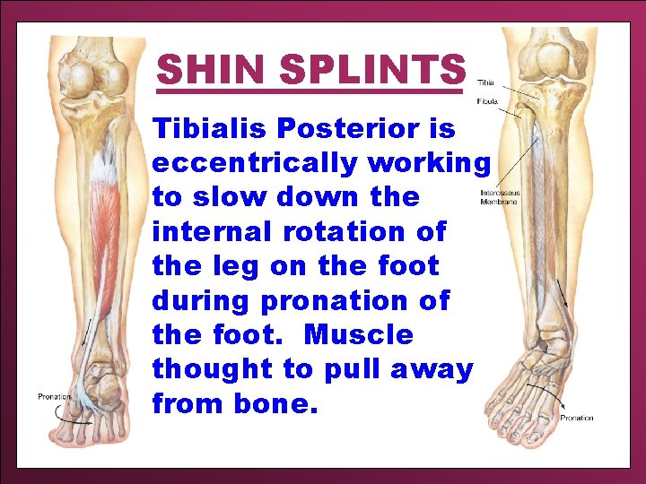 SHIN SPLINTS Tibialis Posterior is eccentrically working to slow down the internal rotation of