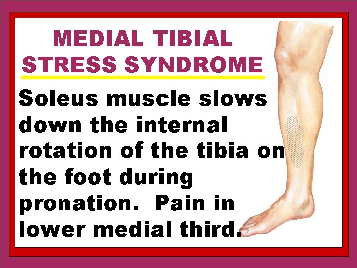 MEDIAL TIBIAL STRESS SYNDROME Soleus muscle slows down the internal rotation of the tibia