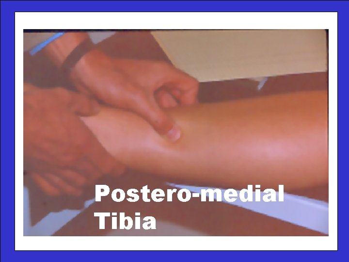Postero-medial Tibia 