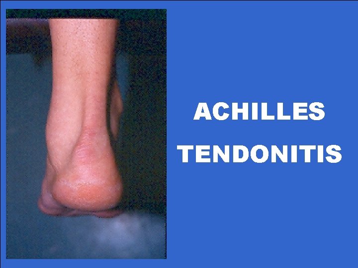 ACHILLES TENDONITIS 