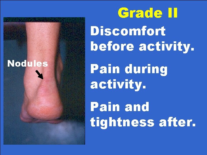 Grade II Discomfort before activity. Nodules Pain during activity. Pain and tightness after. 