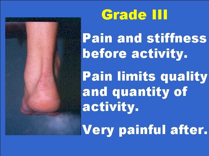Grade III Pain and stiffness before activity. Pain limits quality and quantity of activity.
