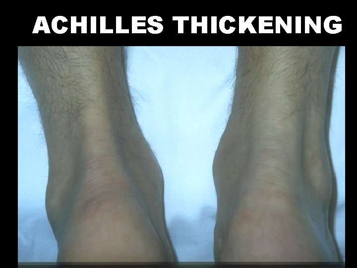 ACHILLES THICKENING 
