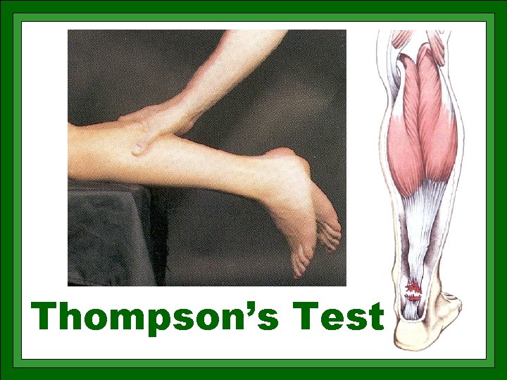Thompson’s Test 