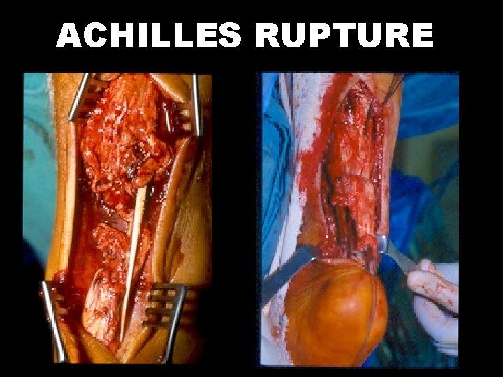 ACHILLES RUPTURE 