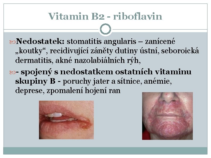 Vitamin B 2 - riboflavin Nedostatek: stomatitis angularis – zanícené „koutky“, recidivující záněty dutiny