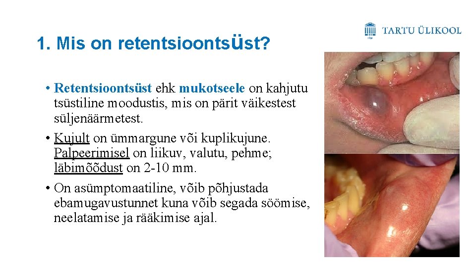 1. Mis on retentsioontsüst? • Retentsioontsüst ehk mukotseele on kahjutu tsüstiline moodustis, mis on 1. Mis on retentsioontsüst? • Retentsioontsüst ehk mukotseele on kahjutu tsüstiline moodustis, mis on