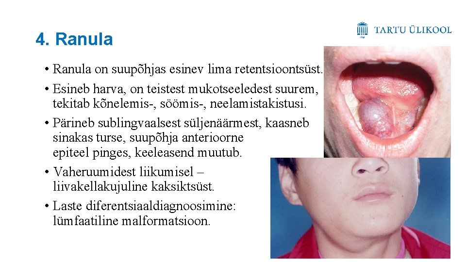 4. Ranula • Ranula on suupõhjas esinev lima retentsioontsüst. • Esineb harva, on teistest
