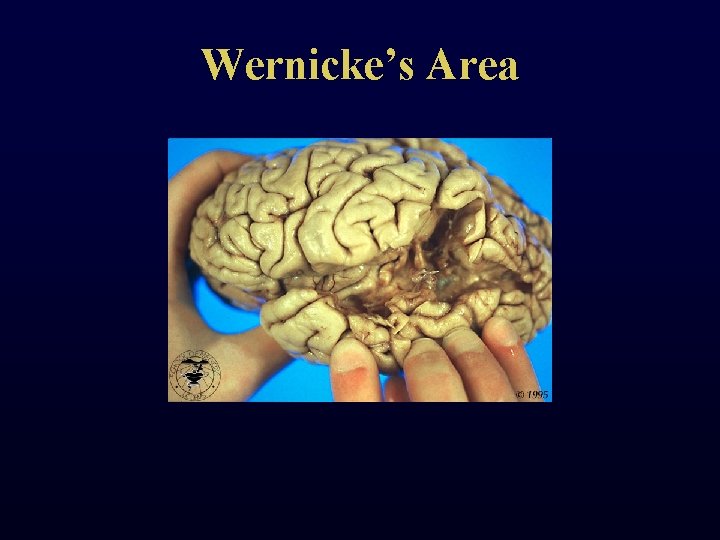 Wernicke’s Area 