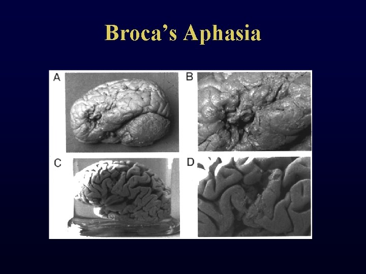 Broca’s Aphasia 