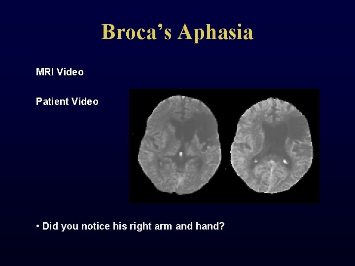 Broca’s Aphasia MRI Video Patient Video • Did you notice his right arm and