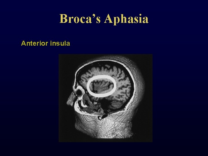 Broca’s Aphasia Anterior insula 