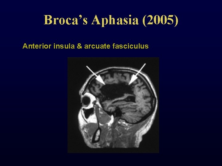 Broca’s Aphasia (2005) Anterior insula & arcuate fasciculus 