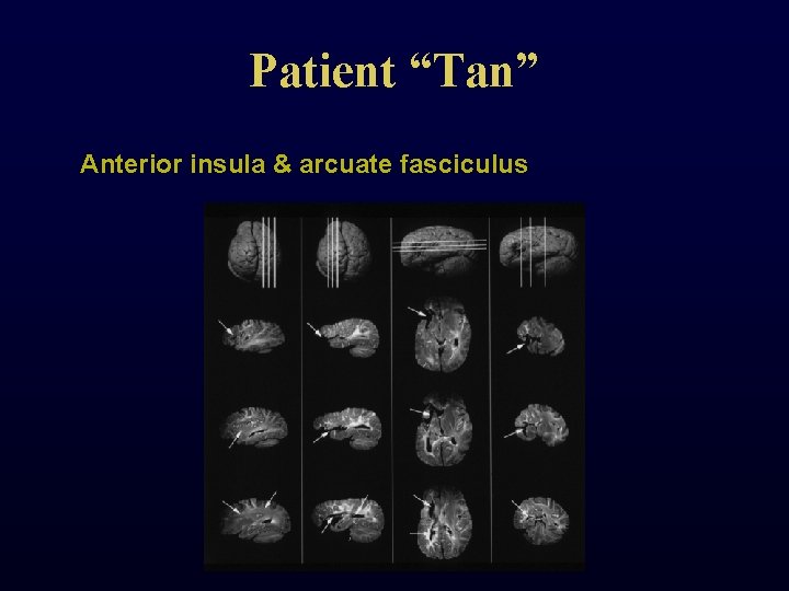 Patient “Tan” Anterior insula & arcuate fasciculus 