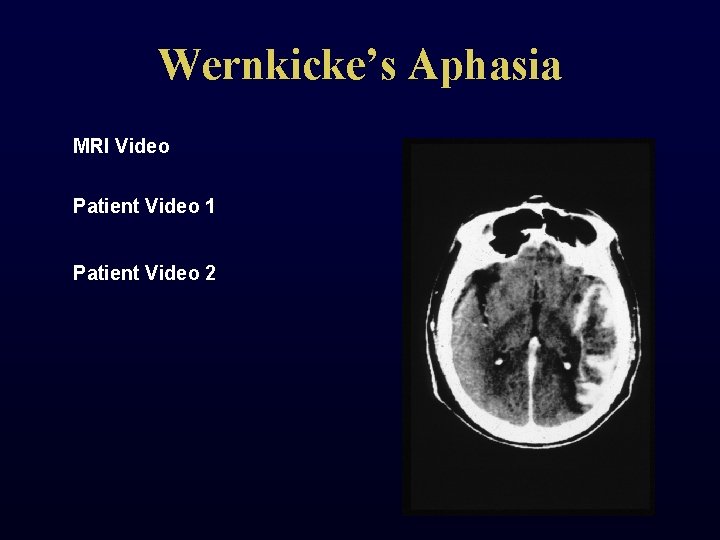 Wernkicke’s Aphasia MRI Video Patient Video 1 Patient Video 2 
