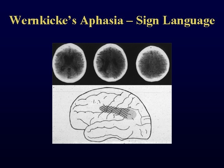 Wernkicke’s Aphasia – Sign Language 