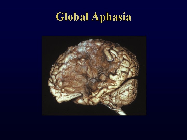 Global Aphasia 