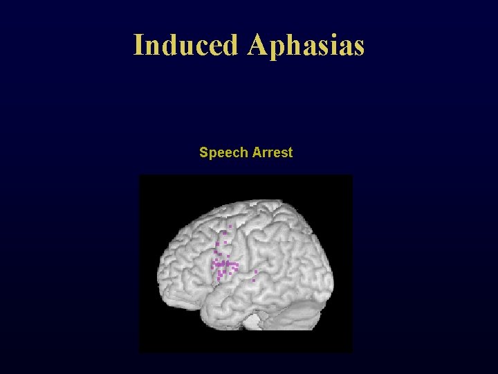 Induced Aphasias Speech Arrest 