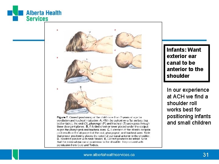 Infants: Want exterior ear canal to be anterior to the shoulder In our experience