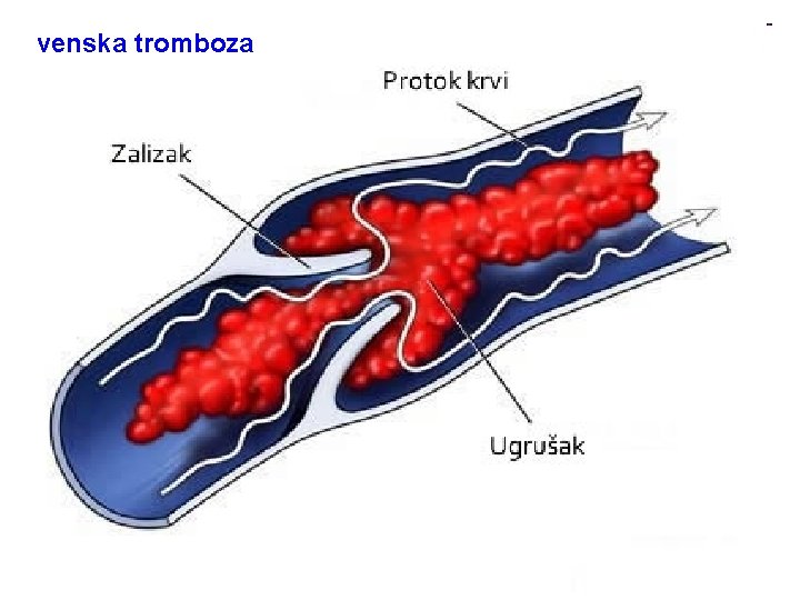 venska tromboza 