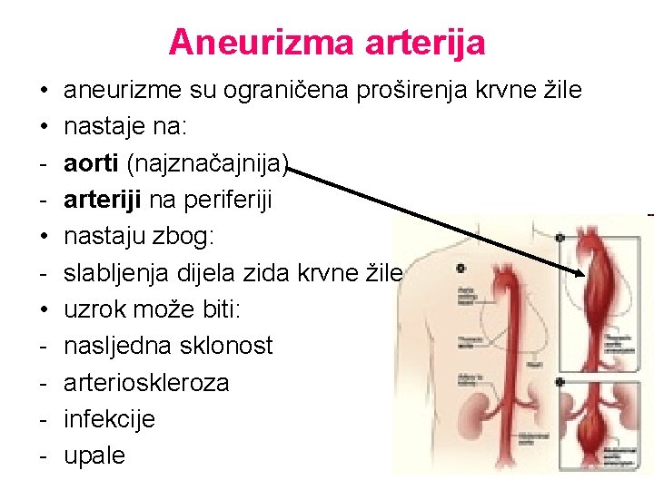 Aneurizma arterija • • - aneurizme su ograničena proširenja krvne žile nastaje na: aorti