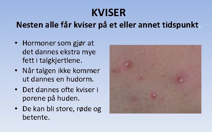 KVISER Nesten alle får kviser på et eller annet tidspunkt. • Hormoner som gjør