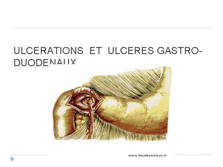 ULCERATIONS ET ULCERES GASTRODUODENAUX 