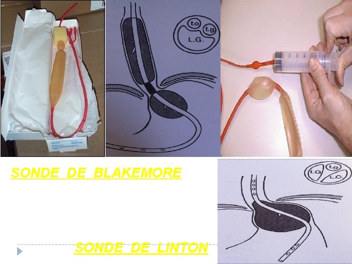 SONDE DE BLAKEMORE SONDE DE LINTON 