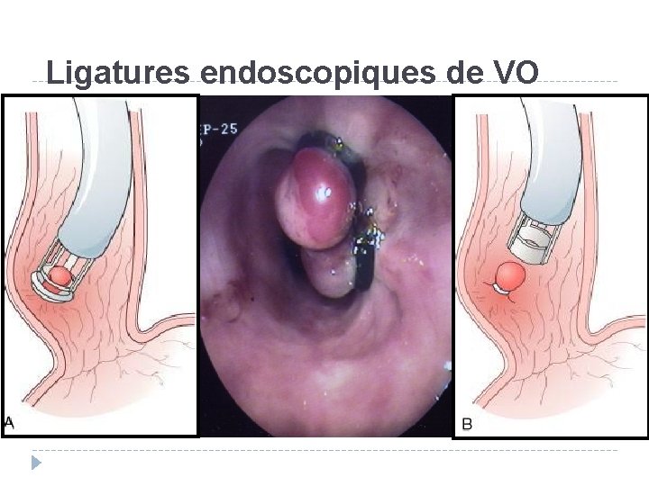 Ligatures endoscopiques de VO 