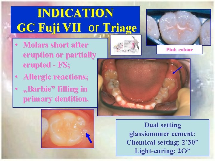 INDICATION GC Fuji VII or Triage • Molars short after eruption or partially erupted