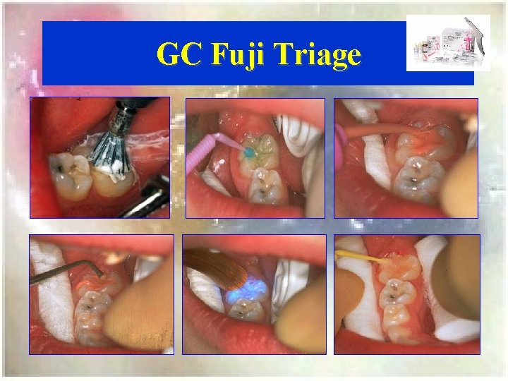 GC Fuji Triage 