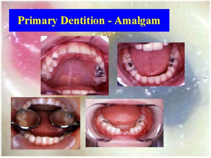 Primary Dentition - Amalgam 