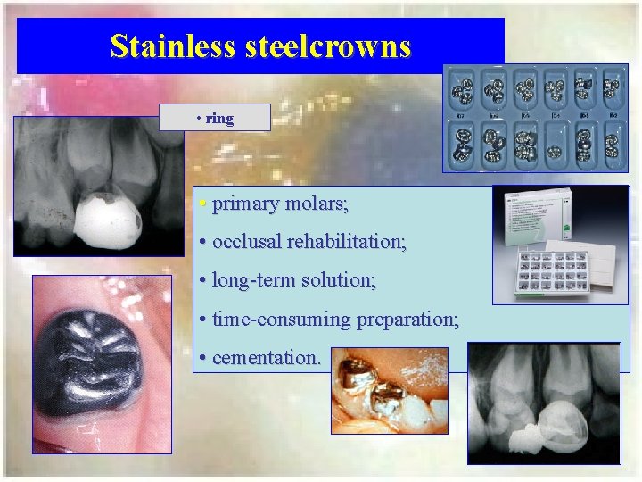 Stainless steelcrowns • ring • primary molars; • occlusal rehabilitation; • long term solution;