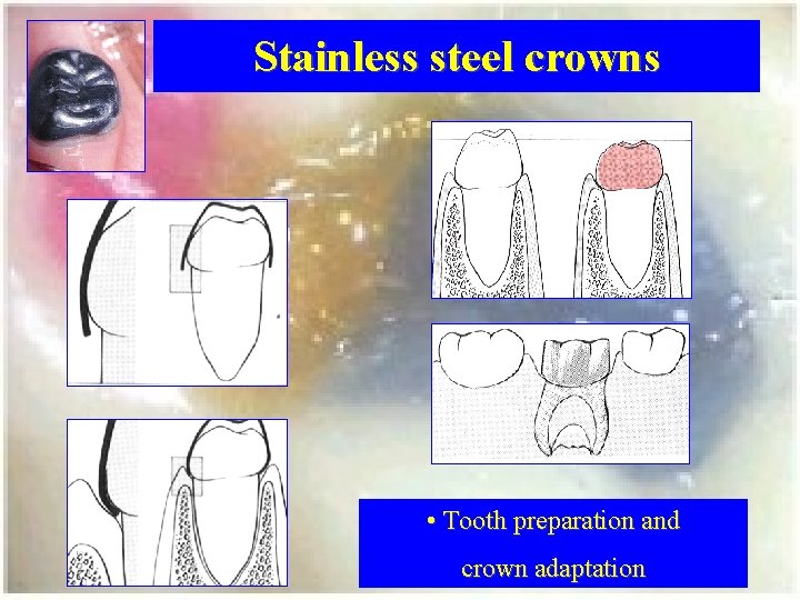 Stainless steel crowns • Tooth preparation and crown adaptation 