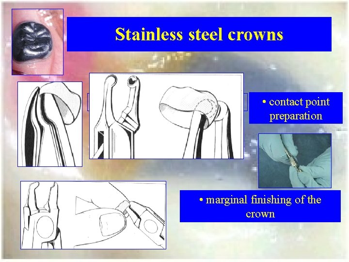 Stainless steel crowns • contact point preparation • marginal finishing of the crown 