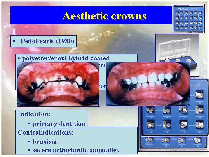 Aesthetic crowns • Pedo. Pearls (1980) • polyester/epoxi hybrid coated prefabcricated aluminium crowns •