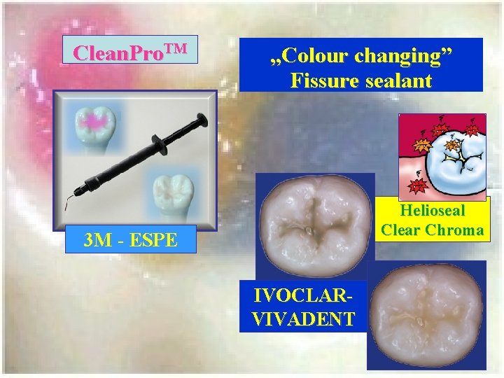 Clean. Pro. TM „Colour changing” Fissure sealant Helioseal Clear Chroma 3 M - ESPE