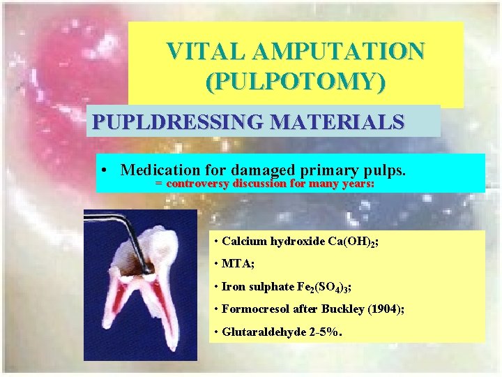 VITAL AMPUTATION (PULPOTOMY) PUPLDRESSING MATERIALS • Medication for damaged primary pulps. = controversy discussion