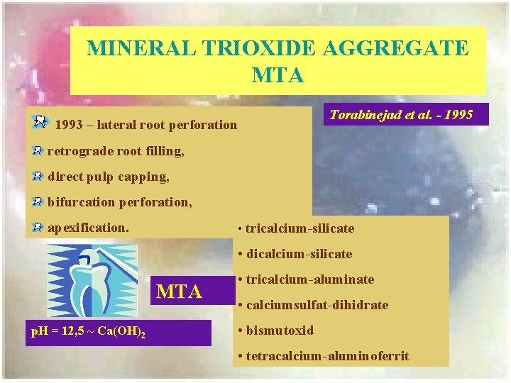 MINERAL TRIOXIDE AGGREGATE MTA 1993 – lateral root perforation Torabinejad et al. - 1995